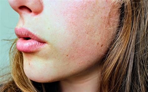Is Your Thyroid Causing Cystic Acne Hypothyroidism And Acne Explained