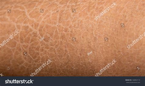 Dry Skin Ichthyosis Detail Stock Photo 160854119 Shutterstock