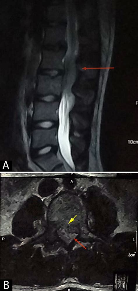 Cureus Extremely Rare Primary Spinal Epidural Indolent Mantle Cell
