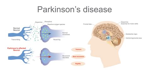 Pramipexole in the treatment of parkinson's disease: Drugs That Suppress Immune System May Protect Against ...