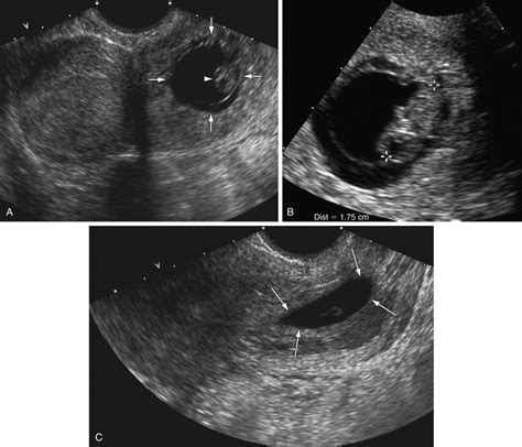 Ultrasound Guided Treatment Of Ectopic Pregnancy Radiology Key