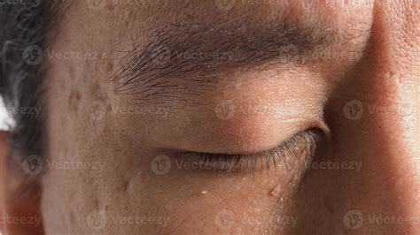 Wart Skin Removal Macro Shot Of Warts Near Eye On Face 7540394 Stock