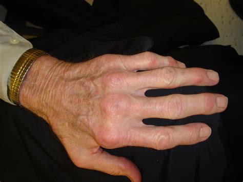 Defining Difficult Rheumatoid Arthritis Rheumnow