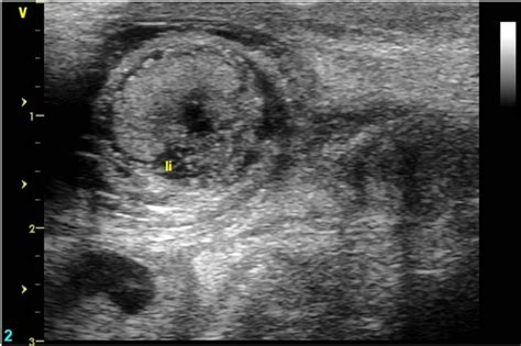 Perinatal Testicular Torsion—an Emergency With Grave Consequences