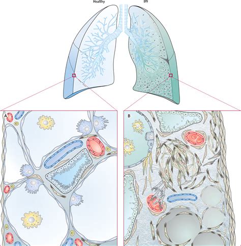 New Cellular And Molecular Mechanisms Of Lung Injury And Fibrosis In