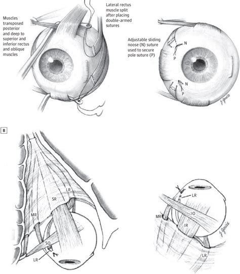 Schematic Interpretation Of Nasal Transposition Of The Split Lateral