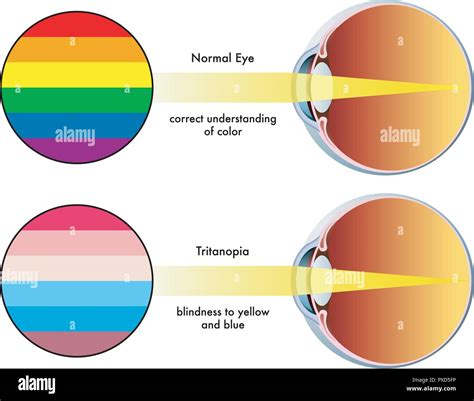 Diagram Color Blind Eye Diagram Mydiagramonline