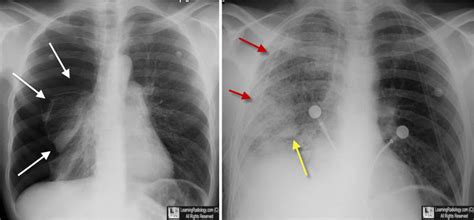 Please see disclaimer on my website www.academyofprofessionals.com. Can You Show Me Some X-ray Pictures of Pulmonary Edema ...