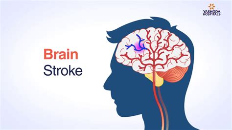 Brain Stroke Symptoms And Treatment Best Treatment For Brain Stroke