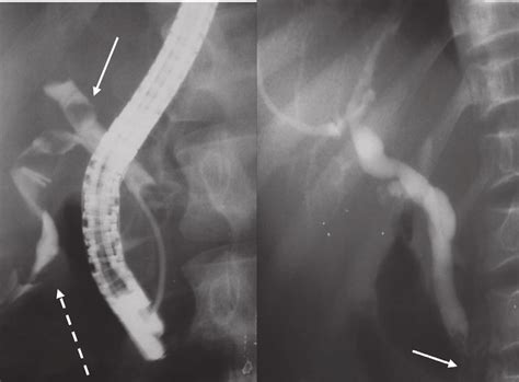 Ercp For Two Patients Showing Bile Leak From The Cystic Duct Dotted