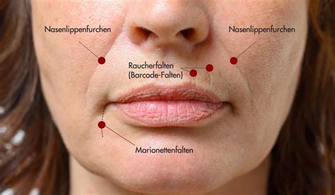 Lippen Und Mundfalten Arten Ursachen Behandlung X