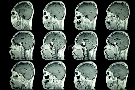 Mri Scan Of Patient Brain Stock Image Image Of Resonance 111820303