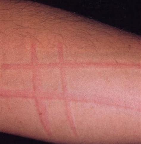 Dermatographism Dermatographia Pictures Causes Treatment And Cures
