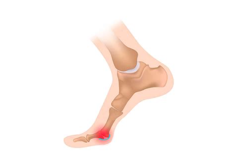 Turf toe most commonly affects athletes playing on rigid surfaces such as artificial turf e.g. Turf Toe - The Runner's Guide on How to Treat a Painful injury