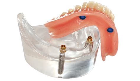 Dental implants, crowns, aesthetic restoration, Implant prosthetic restoration - Cosmetic ...