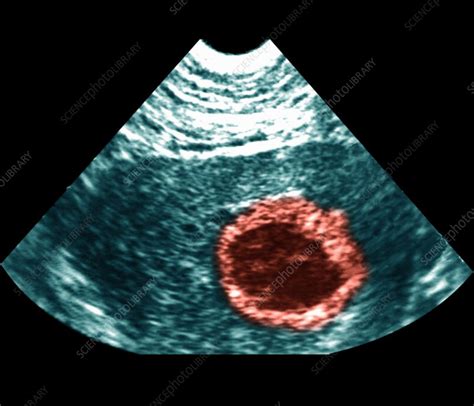 Pregnancy With Iud Ultrasound Scan Stock Image M8500487 Science