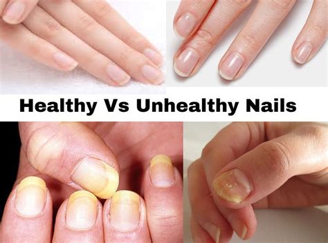 Healthy Vs Unhealthy Nails Steps To Consider Nails Review