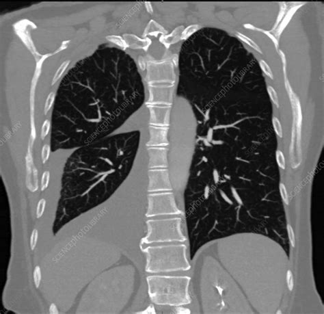 Pleural Effusion Ct Scan Stock Image C0366431 Science Photo Library