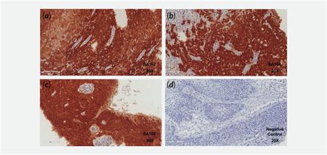 Expression Of P16 Ink4a In Hpv73 Positive Cervix Cancer Specimens
