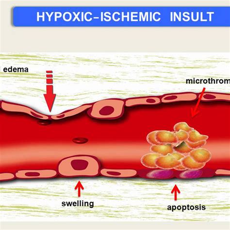 Hypoxic Ischemic Damage In Preterms Download Scientific Diagram