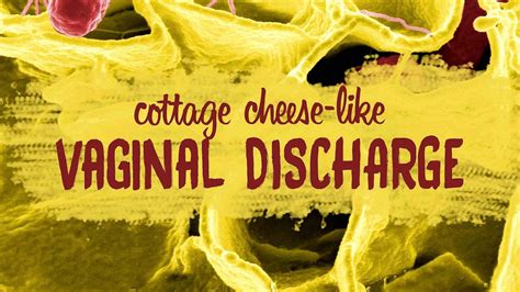 What Causes A Yellow Vaginal Discharge Yellow Choices