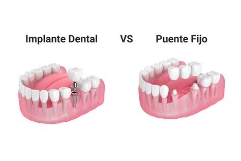 Implantes Dentales Vs Puente Fijo Sonrisa Para Todos