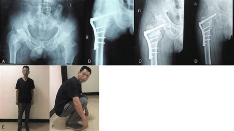 A A 44 Year Old Man Sustained A Right Intertrochanteric Fracture By A