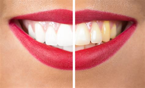 Teeth Whitening Structure Vignet