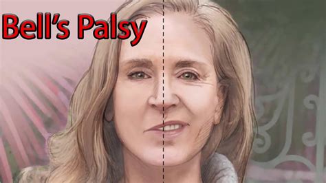 Bells Palsy Causes Symptoms Diagnosis Recovery And Treatment