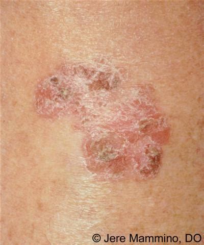 It's rare in women younger than 20. Cervical cancer signs and symptoms Rash - pedalitablog