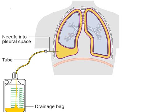 Indwelling Pleural Catheter