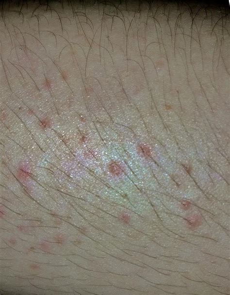21 Female With Skin Rashes Allergic Reaction To Antibiotic R
