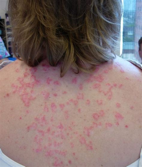 Subacute Cutaneous Lupus Erythematosus