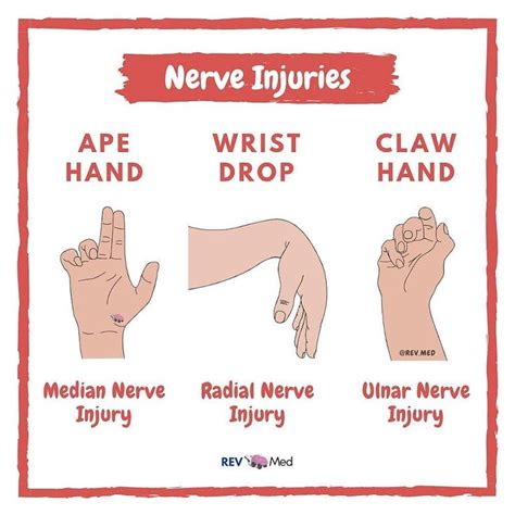 Doctor Medicine On Instagram “ ️median Nerve “ape Hand