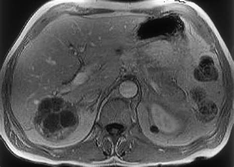 Cystic Focal Liver Lesions In The Adult Differential Ct And Mr Imaging Free Hot Nude Porn Pic