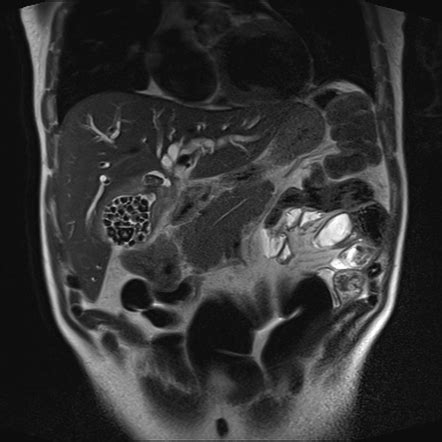 Mirizzi Syndrome Radiology Case Radiopaedia Org