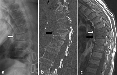 X Ray Images Of Vertebral Compression Fracture A X Ray Images Of