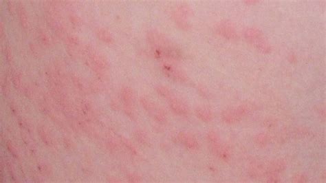 Lung Cancer Caused By Infection Histoplasmosis Types Rash Skin Lung