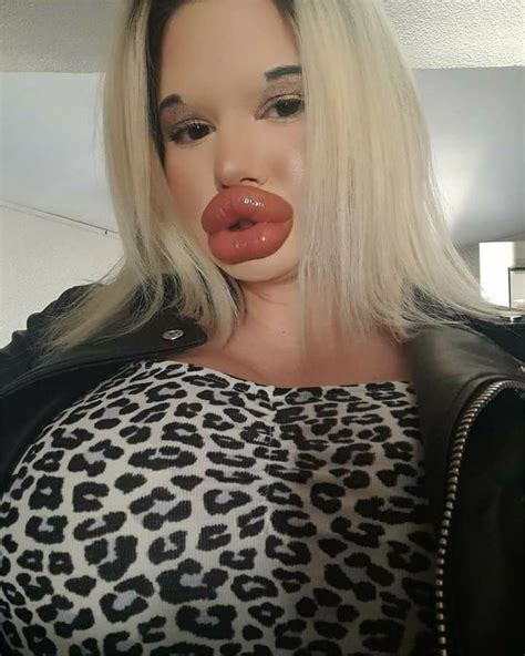 News and Report Daily 蠟 Im addicted to my big lips doctors say I could but I wont stop
