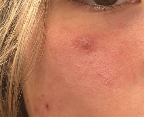 Red Bump On Face