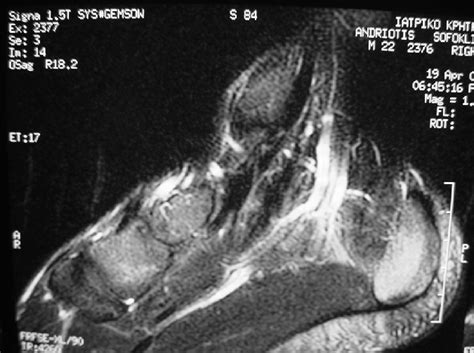 T2 Weighted Sagittal Image Demonstrating The Dilated Tortuous Vein