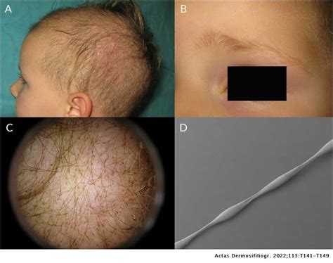 Translated Article Keys To The Diagnosis Of Hair Shaft Disorders