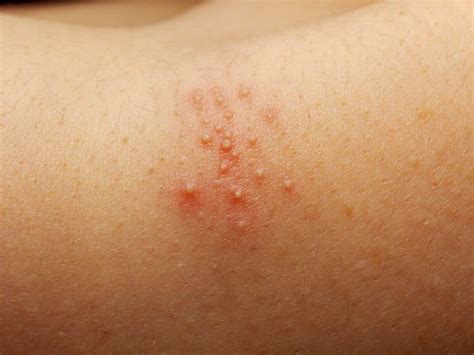 Prickly Heat Rash Miliaria Causes Types Prevention And Treatment My