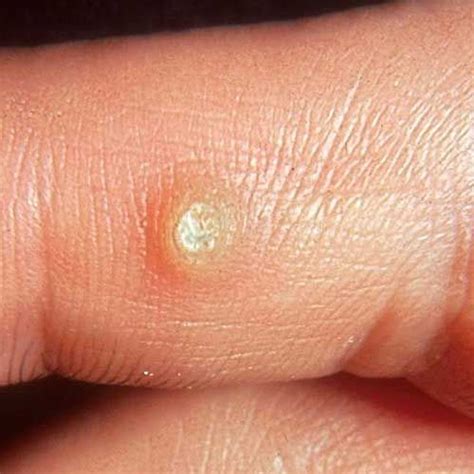 Warts Pictures Thick Wart On Finger Home Remedies For Warts Natural