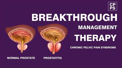 Prostatitis Treatment Male Chronic Pelvic Pain Syndrome Shockwave