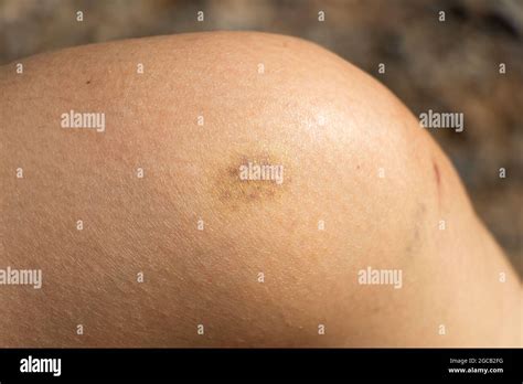 Background Of Bruised Wound On Wound Woman At Knee Skin Stock Photo Alamy