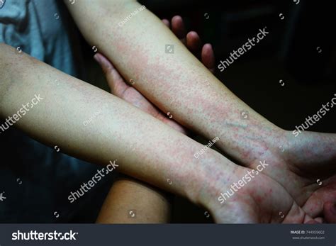 Urticaria Hives On Forearms Itchy Bumps Foto De Stock 744959602
