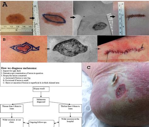 How To Diagnose Melanoma Marsden Skin Cancer Clinic