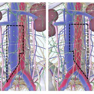 Robot Assisted Retroperitoneal Lymph Node Dissection Template Limits