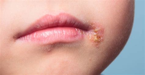 Maybe you would like to learn more about one of these? Infected blister: Symptoms, first aid, treatment, and healing